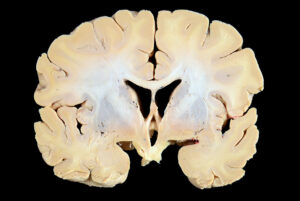 Corte Coronal (10)