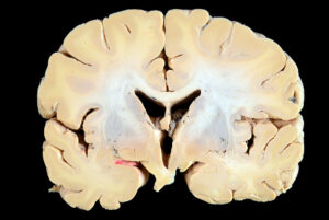 Corte Coronal (11)