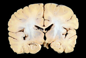 Corte Coronal (12)