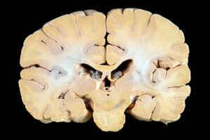 Corte Coronal (13)