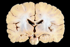 Corte Coronal (14)