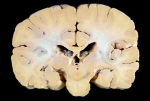 Corte Coronal (15)