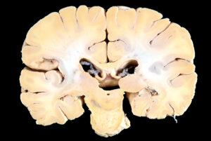 Corte Coronal (17)