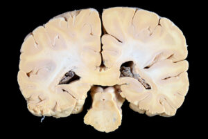 Corte Coronal (18)