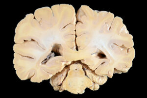 Corte Coronal (19)