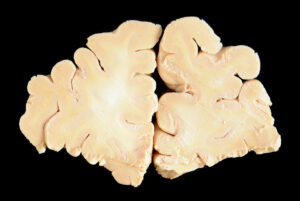 Corte Coronal (2)