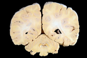 Corte Coronal (20)