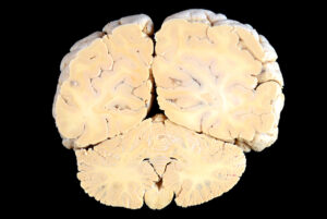 Corte Coronal (21)