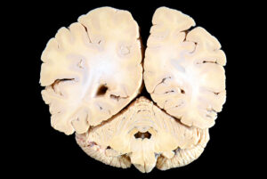 Corte Coronal (22)