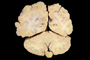 Corte Coronal (23)