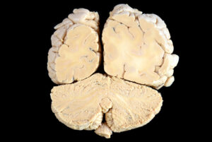 Corte Coronal (24)