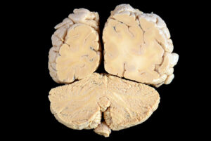 Corte Coronal (25)