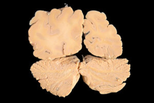 Corte Coronal (26)