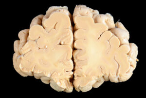 Corte Coronal (3)