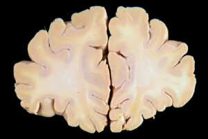 Corte Coronal (4)