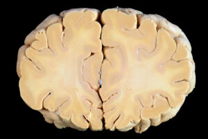 Corte Coronal (5)