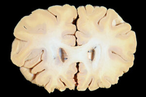 Corte Coronal (6)