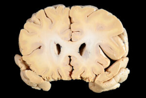 Corte Coronal (7)