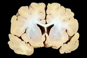 Corte Coronal (8)
