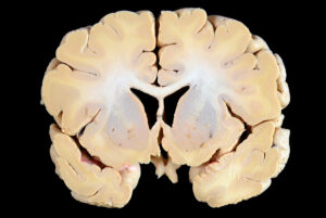 Corte Coronal (9)